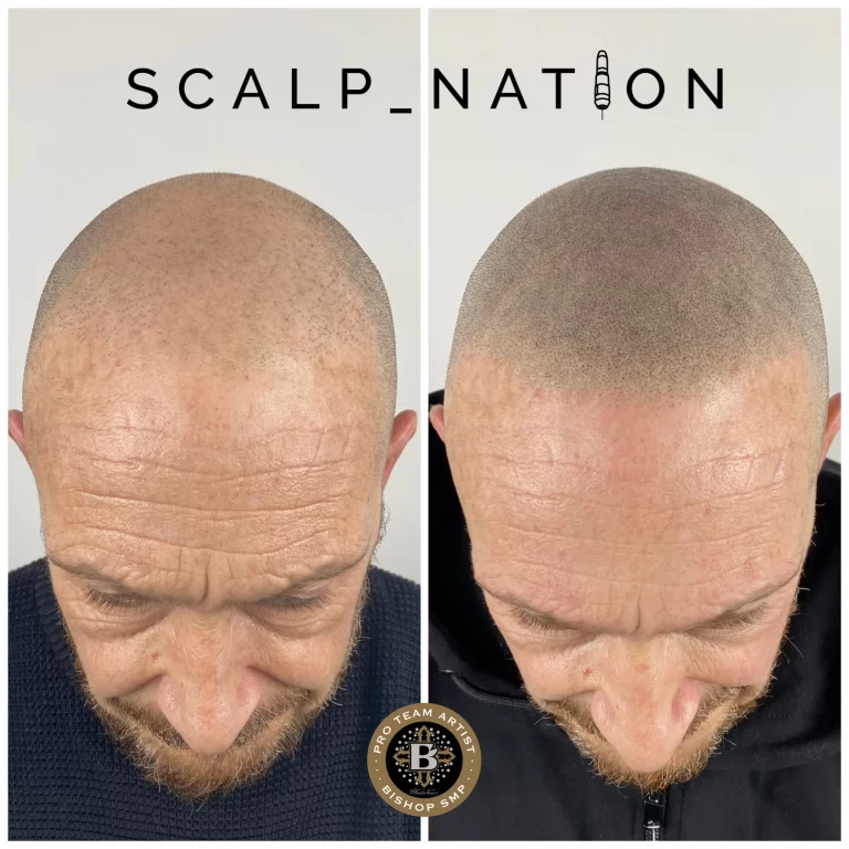 SH-smp-after-hair-transplant-1-768x768