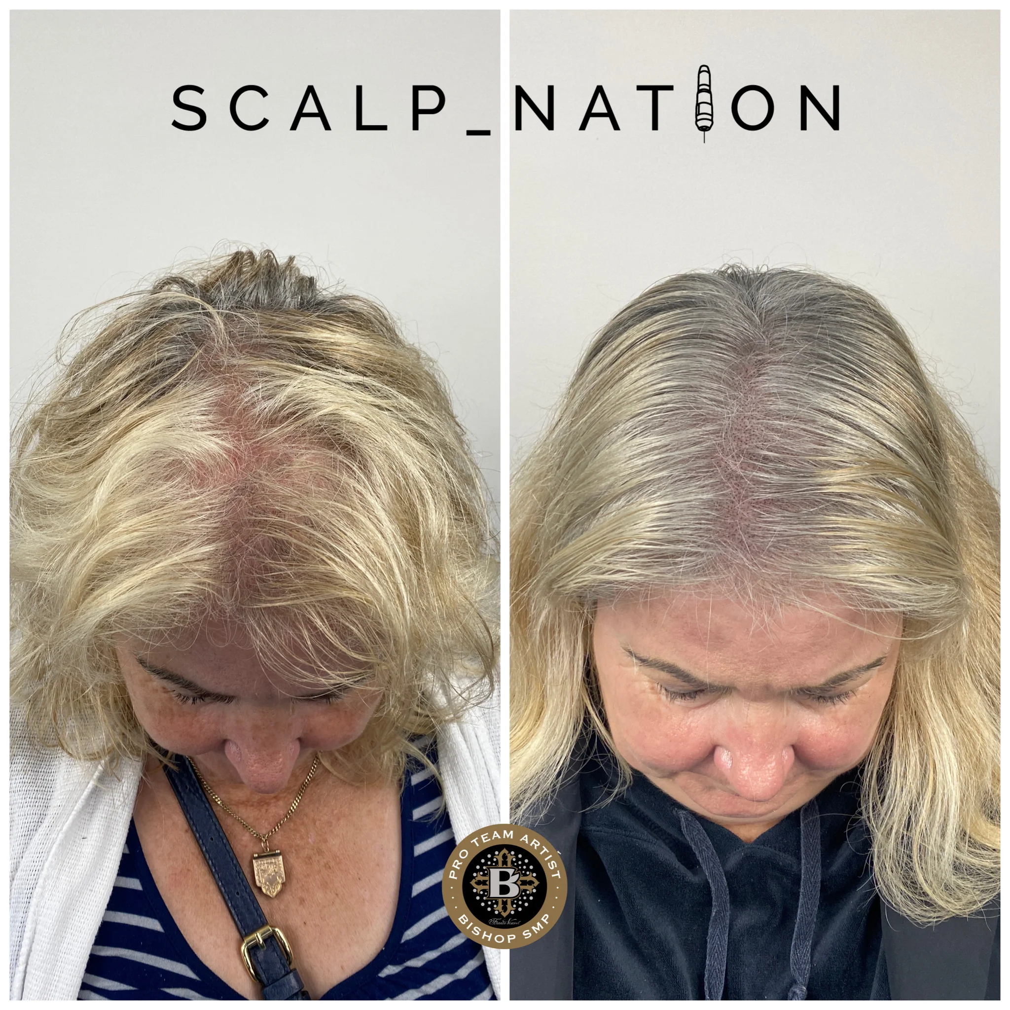 female-density-scalp-micropigmentation-KM1
